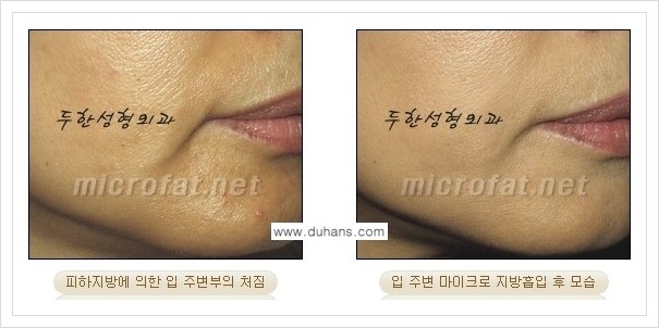 [두한성형외과 겨울엔 지방흡입을] - [볼살, 눈밑, 턱선의 초음파 미세지방흡입 2.] 관련 이미지 8