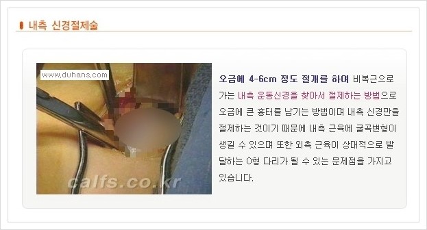 [두한성형외과 경쟁력 멀티종아리성형] - [날씬한 종아리를 만드는 다양한 시술방법의 장점, 단점 안내] 관련 이미지 8