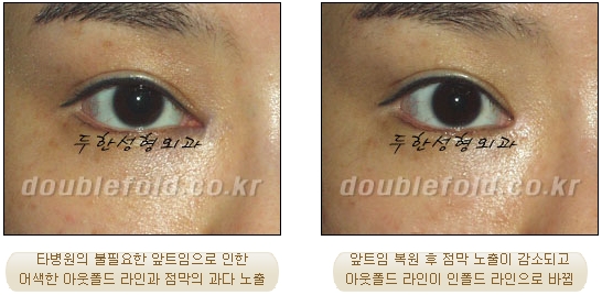 쌍꺼풀수술 두한성형외과 - 쌍커풀재수술의 문제점 관련 이미지 6