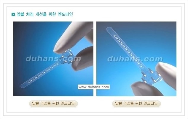 [두한성형외과 경쟁력 주름성형] - [눈썹거상, 앞볼처짐 개선의 엔도타인 리프팅] 관련 이미지 6
