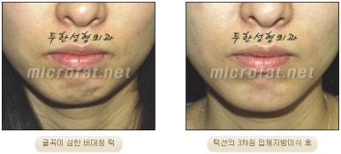 [Duhan Plastic Surgery Clinic Microgenia Correction] - [Chin Microfat Grafting] image 24