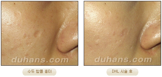 [DuHan Plastic Surgery Scar] - [DHL Simple Scar Treatment] image 12
