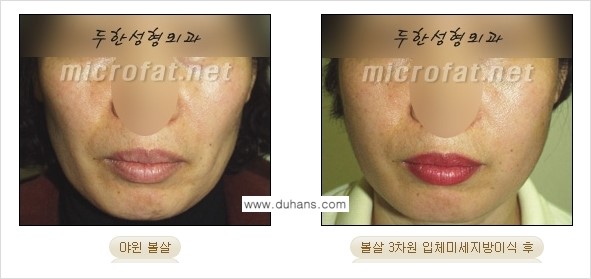 [두한성형외과 경쟁력 미세지방이식] - [두한성형외과 Col-fat(콜펫) 지방이식으로 교정이 가능한 부위 안내] 관련 이미지 7