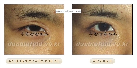 [두한성형외과 경쟁력 눈성형] - [극한의 상태에서 쌍꺼풀재수술(눈재수술) 안내] 관련 이미지 14
