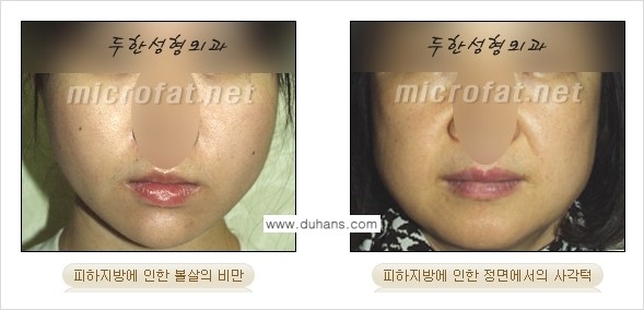[두한성형외과 겨울엔 지방흡입을] - [통통한 볼살, 두툼한 턱선의 지방흡입 1.] 관련 이미지 1