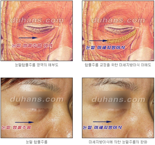 두한성형외과 눈밑성형 - 눈밑지방제거, 눈밑주름, 눈밑지방재배치 관련 이미지 61