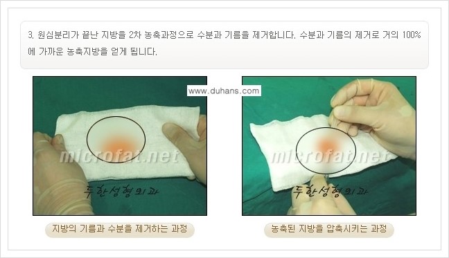 [두한성형외과 경쟁력 지방이식] - [입가주름, 팔자주름 미세지방이식의 안내] 관련 이미지 6