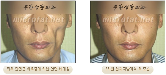얼굴지방이식 두한성형외과 - 볼지방이식 관련 이미지 27