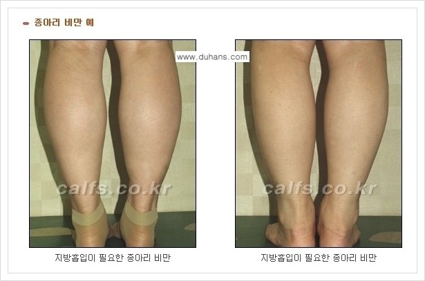 [두한성형외과 경쟁력 멀티종아리성형] - [정교한 미세흡입관 종아리 지방흡입술] 관련 이미지 1