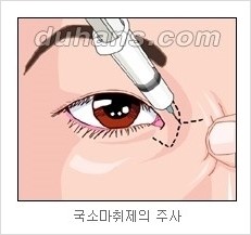 쌍커풀수술 두한성형외과 - 나에게 맞는 눈성형은? 관련 이미지 54