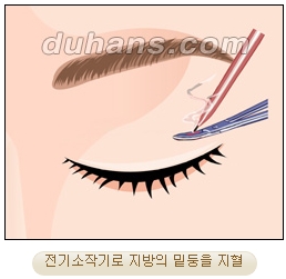 두한성형외과 지방제거 - 눈밑지방, 눈꺼풀지방제거 관련 이미지 8