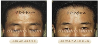 Duhan Plastic Surgery Forehead Surgery - Forehead Lifting Endotine Lifting image 14