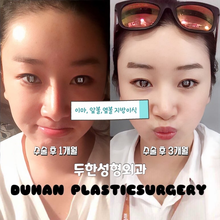 💡 We Design the Face’s ‘Line’ — Not Just Simple Volume Restoration image 2