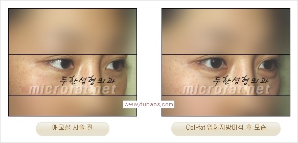 [두한성형외과 경쟁력 지방이식] - [두한 자가지방이식 클리닉 안내]​ 관련 이미지 50
