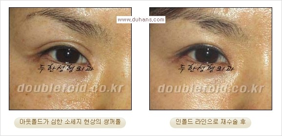 [두한성형외과 경쟁력 눈성형] - [두꺼운 아웃폴드 라인을 인폴드 라인으로 교정] 관련 이미지 2