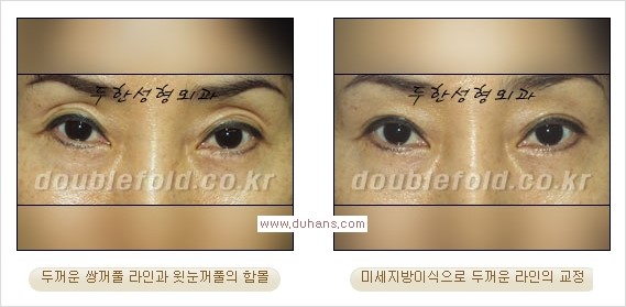 [두한성형외과 경쟁력 쌍꺼풀 재수술] - [쌍꺼풀 재수술 과정] 관련 이미지 92