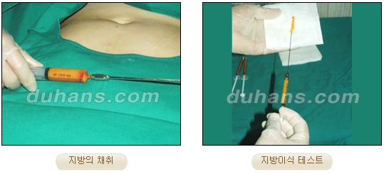 [Duhan Plastic Surgery Facial Autologous Fat Grafting] - [Fat Grafting Guide] image 3
