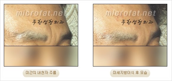 [두한성형외과 경쟁력 지방이식 리더] - [Col-fat(콜펫)지방이식, 3차원 입체지방이식, 2차원 평면지방이식] 관련 이미지 68