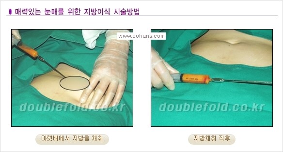 [두한성형외과 경쟁력 눈성형] - [삼중(세겹) 쌍꺼풀 라인의 교정] 관련 이미지 13