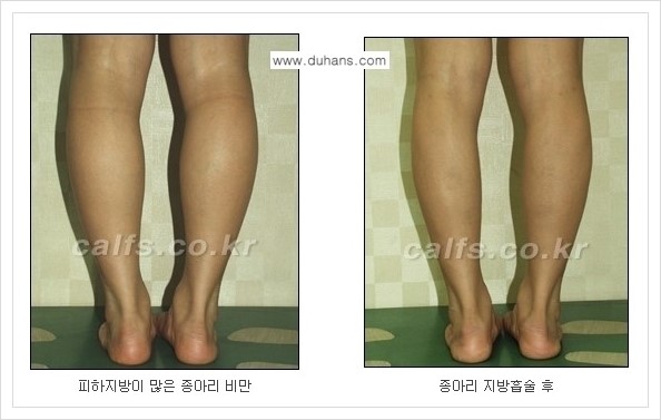 [두한성형외과 경쟁력 멀티종아리성형] - [정교한 미세흡입관 종아리 지방흡입술] 관련 이미지 10