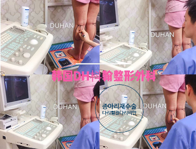 Duhan Plastic Surgery Calf Surgery - Precautions Before and After Calf Surgery image 61