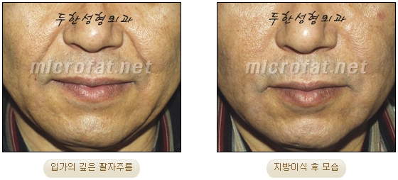 Wrinkle Improvement, Duhan Plastic Surgery - Mouth Lines, Nasolabial Folds image 18