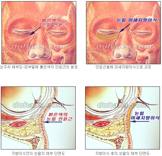 두한성형외과 눈밑성형 - 눈밑지방제거, 눈밑주름, 눈밑지방재배치 관련 이미지 57
