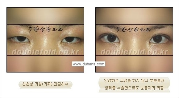 ⁠⁠[두한성형외과 경﻿쟁력 쌍꺼풀 재수술] - [안검하수(졸리운 눈매) 종류와 교정 방법 안내] 관련 이미지 4