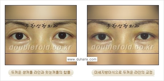 [두한성형외과 경쟁력 눈성형] - [미세지방이식으로 두꺼운 쌍꺼풀 라인의 교정 방법 안내] 관련 이미지 9