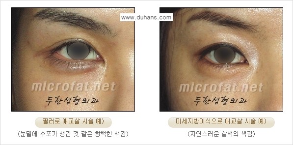 [두한성형외과 경쟁력 눈밑성형] - [눈밑 다크써클과 눈밑 애교살과의 관계 2.] 관련 이미지 3