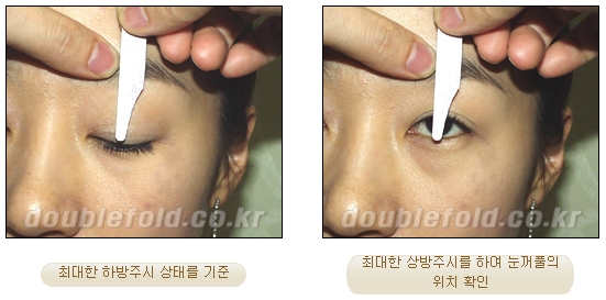 [Duhan Plastic Surgery Reoperation for Double Eyelids] - [Lowering the Double Eyelid Line] image 15