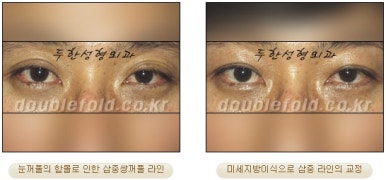 눈성형잘하는곳 두한성형외과 - 겹쌍꺼풀 관련 이미지 33