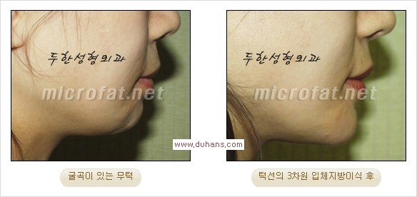 [두한성형외과 경쟁력 미세지방이식] - [부드럽고 아름다운 얼굴윤곽선 턱(하악부) 미세지방이식 안내] 관련 이미지 26