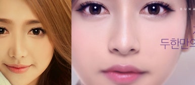 [두한성형외과 코재수술] - [코지방이식] 관련 이미지 3