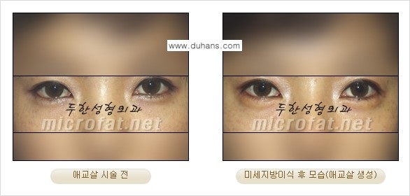 [두한성형외과 무한 경쟁력 눈밑성형] - [애교살 시술 1.] 관련 이미지 6