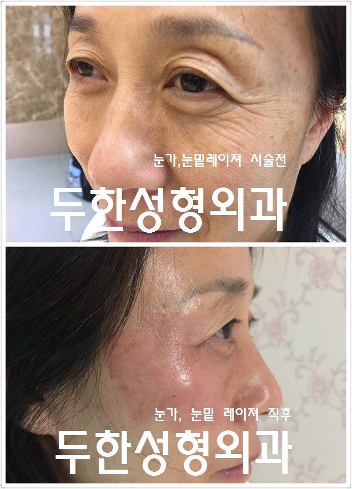 눈가, 눈밑레이져 #눈가주름 #눈밑주름 #눈밑 #눈밑치료 #주름개선 관련 이미지 1