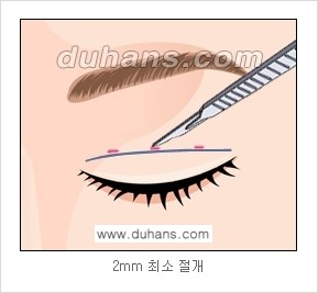 ​[두한성형외과 경쟁력 눈성형] - [자연스러운면서 매력적인 쌍꺼풀 퀵 쌍꺼풀 수술 안내] 관련 이미지 7