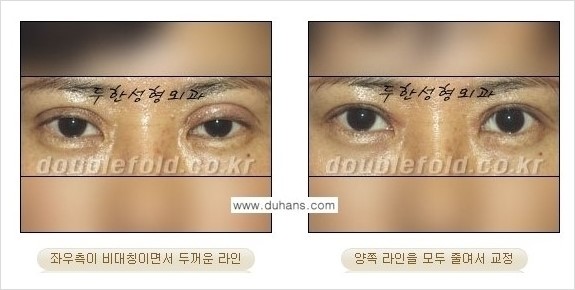 [두한성형외과 경쟁력 쌍꺼풀 재수술] - [짝짝이 쌍꺼풀 라인 교정] 관련 이미지 8