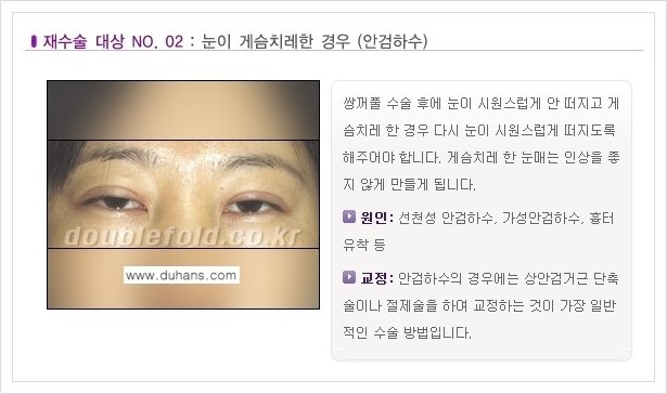 ⁠⁠[두한성형외과 경쟁력 쌍꺼풀 재수술, 극한 재수술] - [쌍꺼풀 재수술이 필요한 경우 안내] 관련 이미지 3