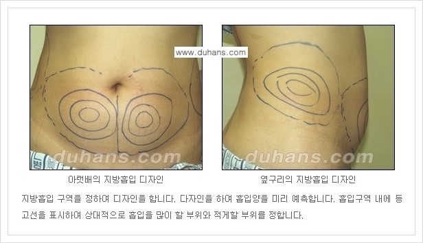 [두한성형외과 경쟁력 초음파 간편지방흡입] - [복부지방흡입, 허벅지지방흡입, 엉덩이지방흡입, 팔뚝지방흡입 안내] 관련 이미지 10