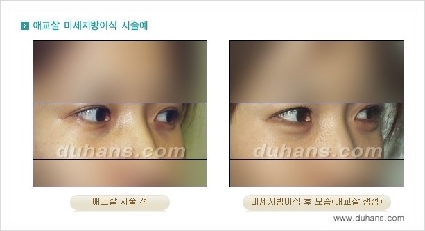 [두한성형외과 경쟁력 눈밑성형] - [눈밑 애교살 시술을 위한 미세지방이식 안내] 관련 이미지 3