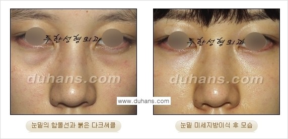 [두한성형외과 상큼하고 환한 눈매완성] - [눈밑 미세지방이식 ①] 관련 이미지 5