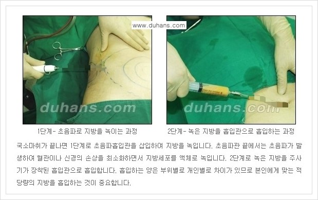 [두한성형외과 경쟁력 지방흡입] - [초음파 간편지방흡입 안내 ②] 관련 이미지 4