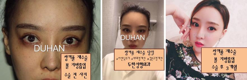 Candidates for Double Eyelid Revision Surgery: Unattractive Double Eyelids, Beautiful Double Eyelids image 38