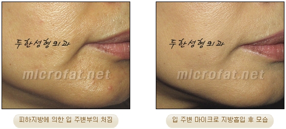 [Duhan Plastic Surgery Liposuction] - [Facial Liposuction] image 30
