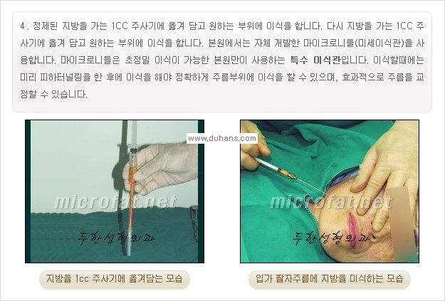 [두한성형외과 경쟁력 주름성형] - [입가와 팔자의 주름제거 지방이식 1.] 관련 이미지 6