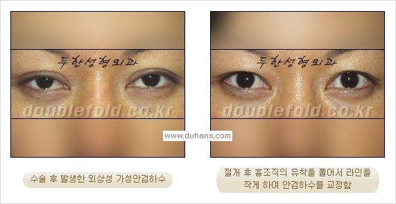 [두한성형외과 경쟁력 눈성형] - [안검하수(졸린눈매) 눈매교정 여러 가지 방법 안내] 관련 이미지 6