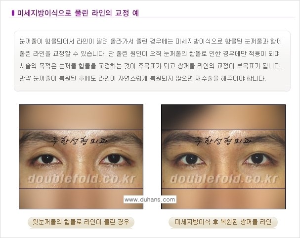 [두한성형외과 NO.1 눈성형] - [함몰된(꺼진) 눈꺼풀에서 쌍꺼풀 라인 교정 3.] 관련 이미지 7