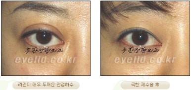 Duhan Plastic Surgery Ophthalmic Reoperation - What Is a Successful Double Eyelid Revision Surgery? image 19