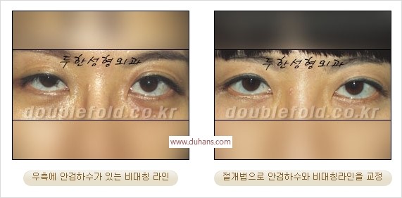 [두한성형외과 경쟁력 눈성형] - [안검하수(졸린눈매) 눈매교정 여러 가지 방법 안내] 관련 이미지 21
